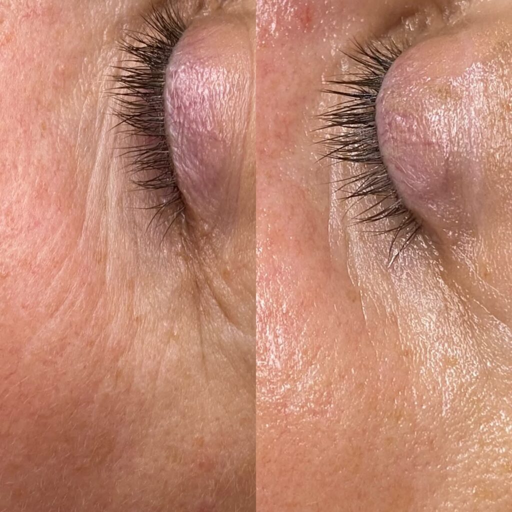 Microneedling