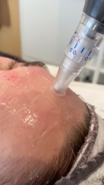 Microneedling